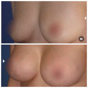 Resultados de lifting de senos antes y después en Centro Médico Teknon, mejor contorno