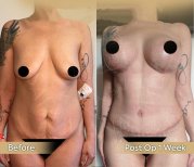Vorher-nachher-Ergebnis Bauchdeckenstraffung bei Dr. Safa Manav Clinic, sichtbare Konturverbesserung
