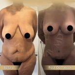 Vorher-nachher-Ergebnis Bauchdeckenstraffung bei Dr. Safa Manav Clinic, sichtbare Kontur