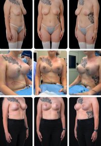 Before and after breast lift results at Yurchenko Plastic Surgery Team Kyiv, improved breast shape