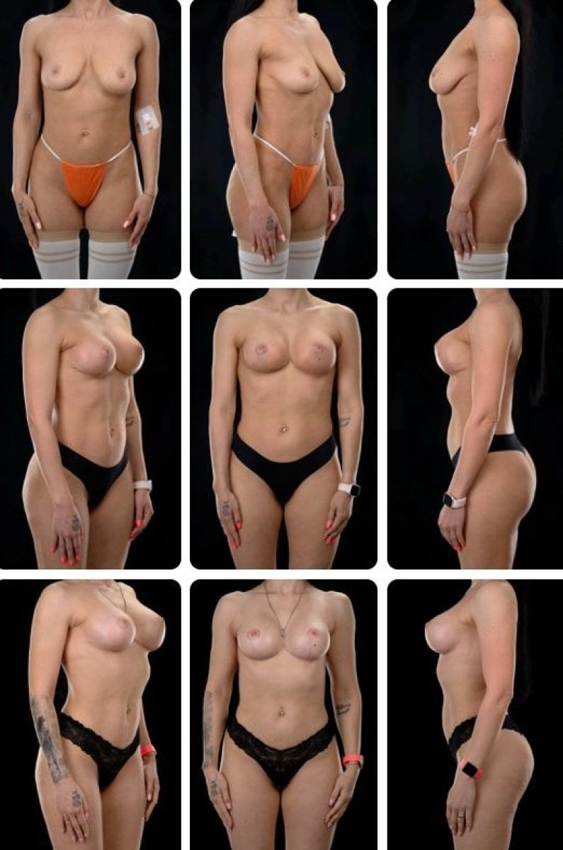 Before and after breast lift results at Yurchenko Plastic Surgery Team Kyiv, improved contour