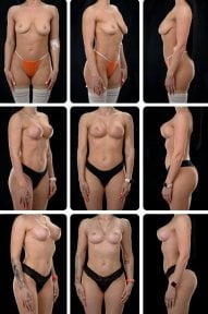 Before and after breast lift results at Yurchenko Plastic Surgery Team Kyiv, improved contour