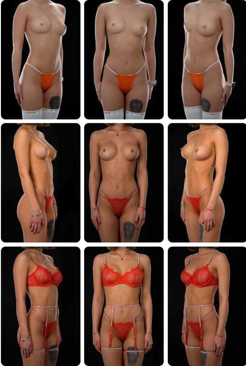 نتائج قبل وبعد تكبير الثدي في Yurchenko Plastic Surgery Team Kyiv، شكل محسن