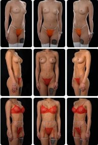 Результати до і після збільшення грудей у Yurchenko Plastic Surgery Team Kyiv, покращена форма