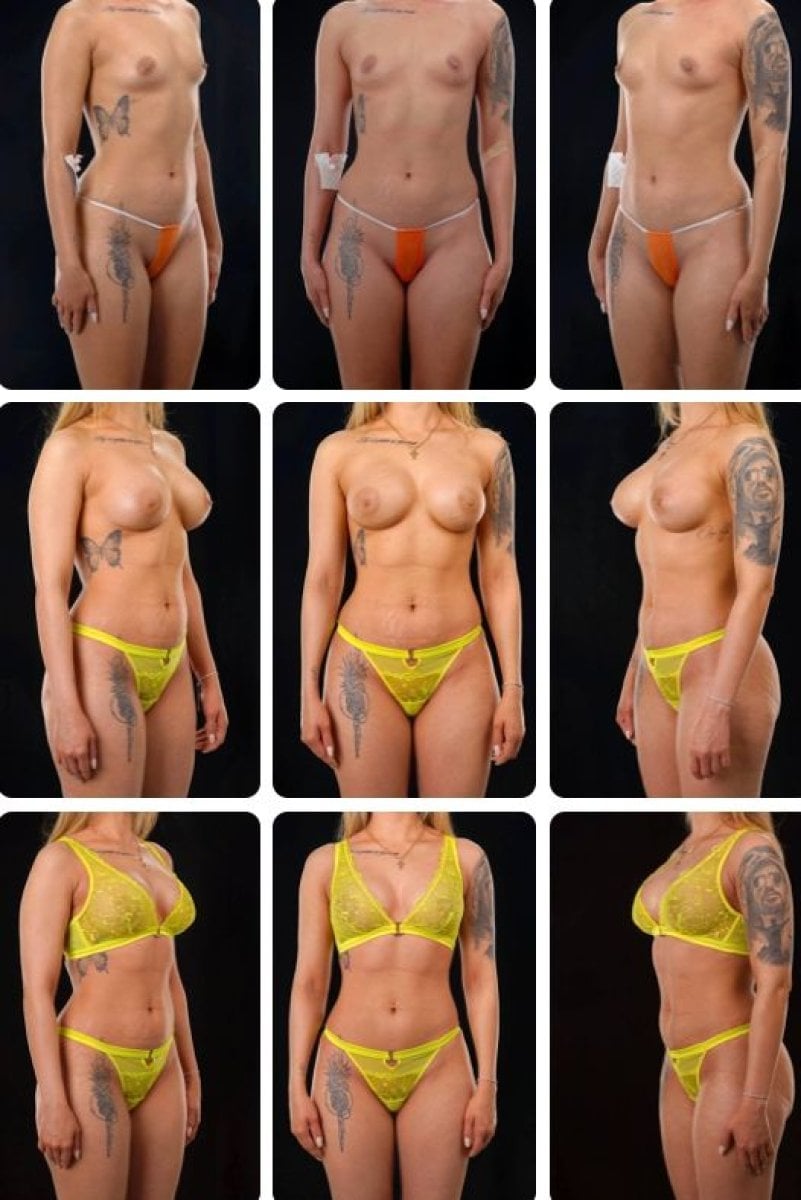 نتائج قبل وبعد تكبير الثدي في Yurchenko Plastic Surgery Team Kyiv، شكل محسن