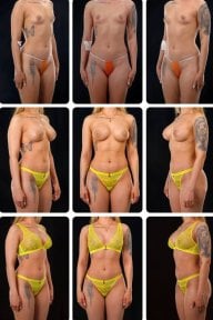 Before and after breast augmentation results at Yurchenko Plastic Surgery Team Kyiv, enhanced shape
