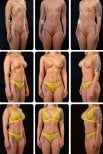 Before and after breast augmentation results at Yurchenko Plastic Surgery Team Kyiv, enhanced shape