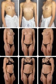 نتائج قبل وبعد تكبير الثدي في Yurchenko Plastic Surgery Team كييف