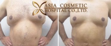 Gynecomastia surgery before and after results at Asia Cosmetic Hospital, male chest contouring