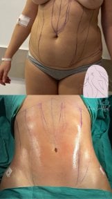 Before and after Vaser liposuction results at Dr. MED – visible abdominal contour improvement