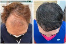 نتائج زراعة الشعر قبل وبعد في He Clinic Bangkok مع استعادة كثافة الشعر