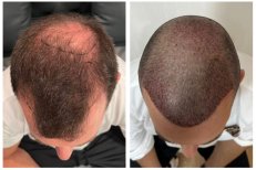 نتائج زراعة الشعر قبل وبعد في He Clinic Bangkok، كثافة شعر محسنة واضحة