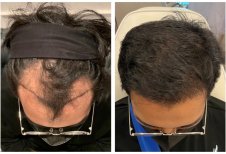 نتائج زراعة الشعر قبل وبعد في He Clinic Bangkok، استعادة خط الشعر الممتلئ
