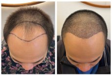 نتائج زراعة الشعر قبل وبعد في He Clinic Bangkok، استعادة خط وكثافة الشعر