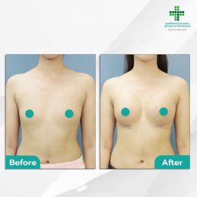 Vorher-nachher-Ergebnisse der Brustvergrößerung in der Intrarat Klinik – mehr Brustvolumen