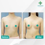 Vorher-nachher-Ergebnisse der Brustvergrößerung in der Intrarat Klinik – mehr Brustvolumen