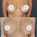 Before and after breast lift with round implants at Dr. MED, visible contour improvement result