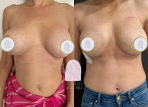Before and after breast lift with round implants at Dr. MED, enhanced breast contour result