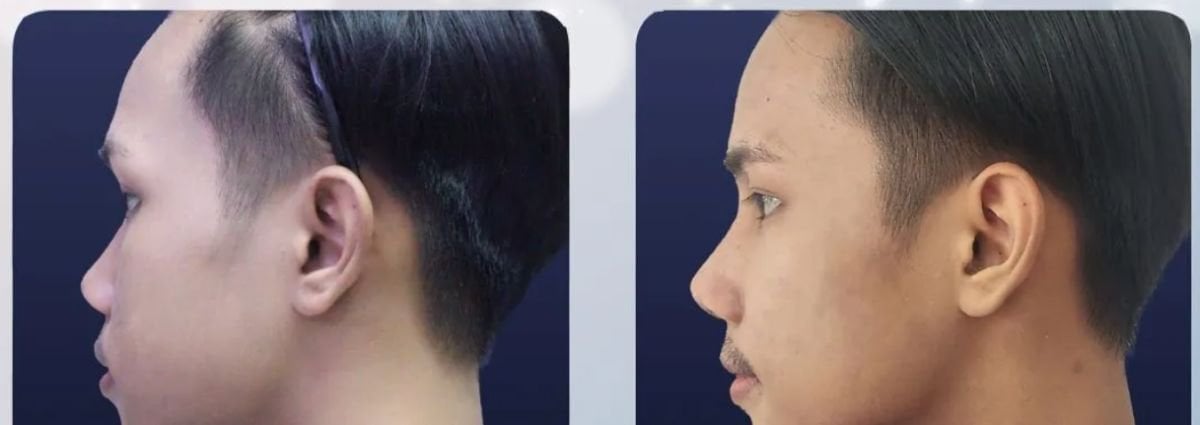 Before and after tip rhinoplasty results at Asia Cosmetic Hospital, improved nose profile