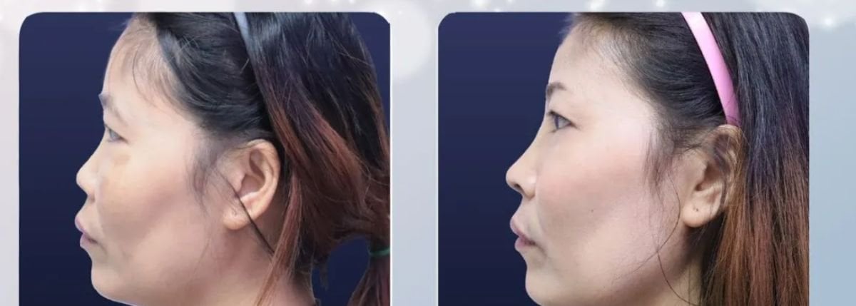 Before and after tip rhinoplasty results at Asia Cosmetic Hospital, improved nose shape profile