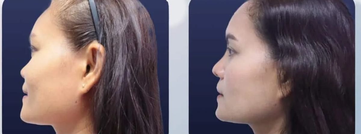 Before and after tip rhinoplasty results at Asia Cosmetic Hospital, improved nose profile