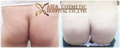 Resultados antes y después de Brazilian Butt Lift en Asia Cosmetic Hospital, glúteos mejorados