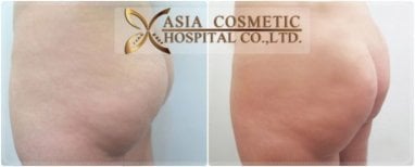 Resultados antes y después de Brazilian Butt Lift en Asia Cosmetic Hospital, glúteos mejorados
