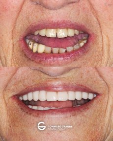 Before and after All-on-4 dental implants result at Tommaso Grandi Dental Clinic, smile restoration