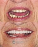 Before and after All-on-4 dental implants result at Tommaso Grandi Dental Clinic, smile restoration