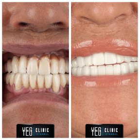 Vorher-nachher-Ergebnis Porzellanveneers bei YEG Clinic – weißeres Lächeln
