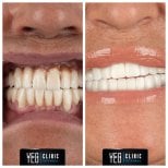 Vorher-nachher-Ergebnis Porzellanveneers bei YEG Clinic – weißeres Lächeln