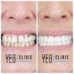 Vorher-nachher-Ergebnis Porzellanveneers bei YEG Clinic – weißeres Lächeln