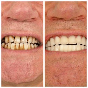 Vorher-nachher-Ergebnis Porzellanveneers bei YEG Clinic – weißeres Lächeln