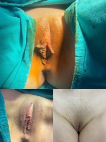 Before and after labia reduction results at ID Clinic Bangkok, improved labial contour visible