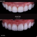Vorher-nachher-Ergebnisse von Keramikveneers bei Hachi Dental Clinic & Digital Veneer Lab