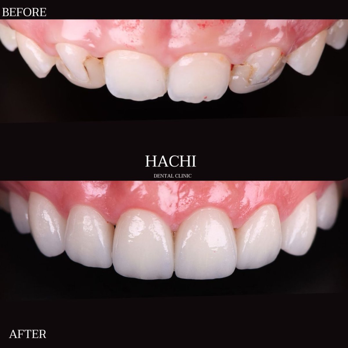 نتائج قبل وبعد قشور البورسلين في Hachi Dental Clinic & Digital Veneer Lab