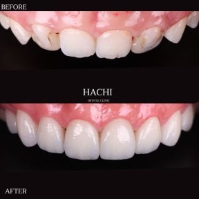 Vorher-nachher-Ergebnis von Porzellanveneers bei Hachi Dental Clinic & Digital Veneer Lab