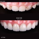 Vorher-nachher-Ergebnis von Porzellanveneers bei Hachi Dental Clinic & Digital Veneer Lab