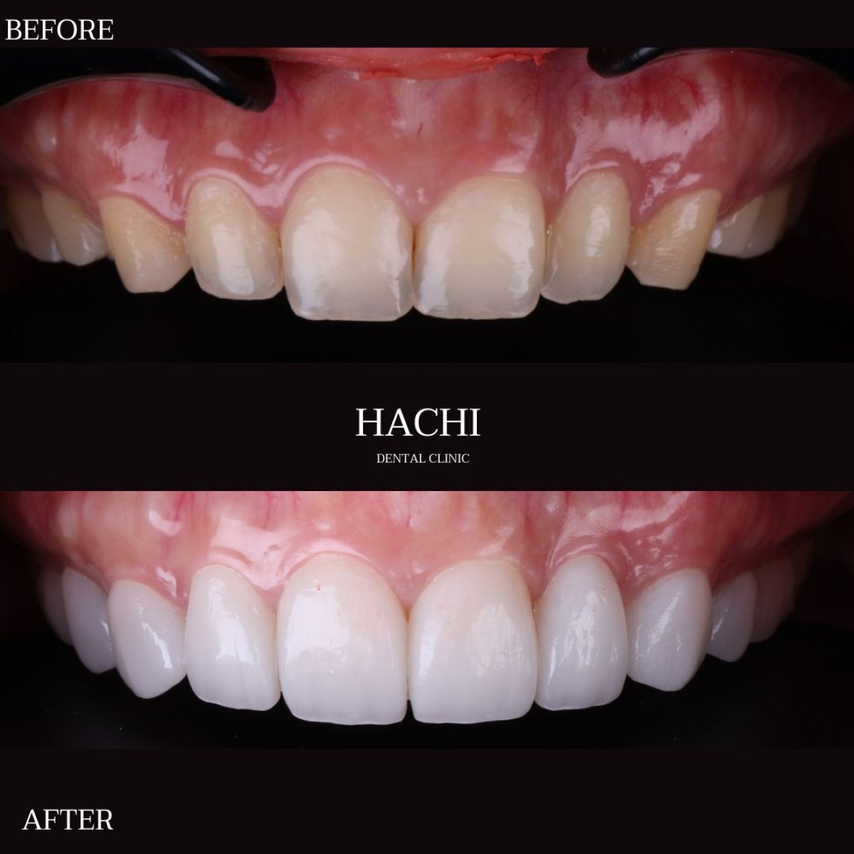 Resultados antes y después de carillas de porcelana en Hachi Dental Clinic & Digital Veneer Lab