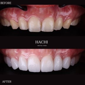 Vorher-nachher-Ergebnisse von Porzellanveneers bei Hachi Dental Clinic & Digital Veneer Lab