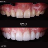 Vorher-nachher-Ergebnisse von Porzellanveneers bei Hachi Dental Clinic & Digital Veneer Lab