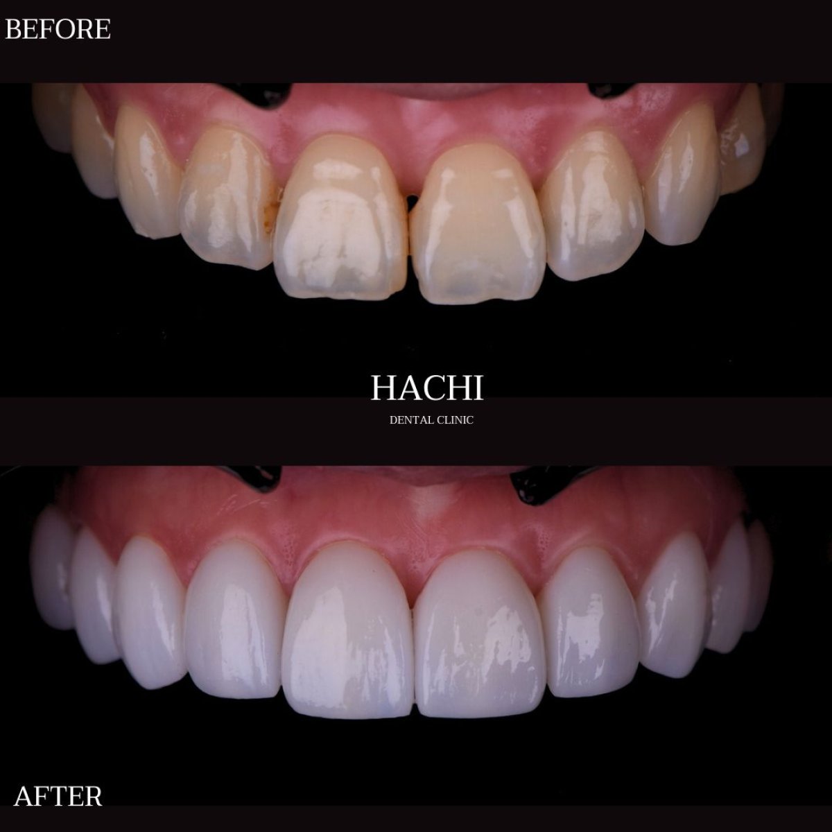 نتائج قبل وبعد قشور البورسلين في Hachi Dental Clinic & Digital Veneer Lab