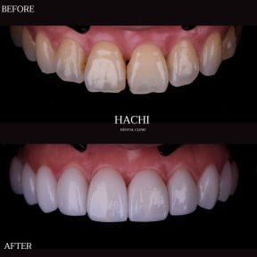 Vorher-nachher-Ergebnisse von Porzellanveneers bei Hachi Dental Clinic & Digital Veneer Lab