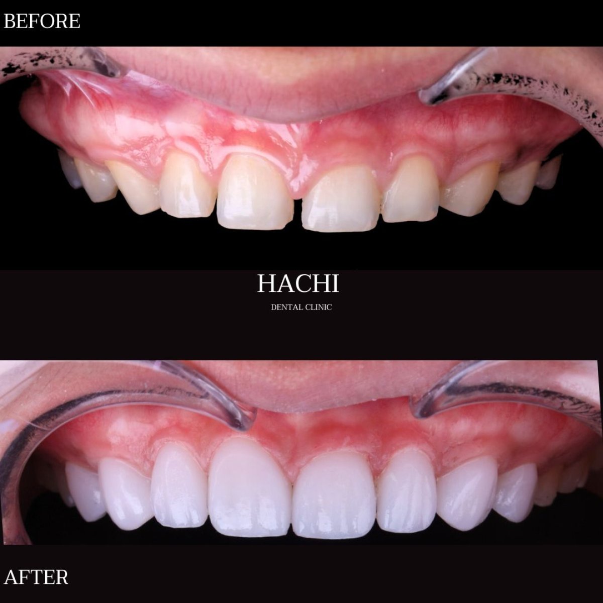 نتائج قبل وبعد عدسات الأسنان الخزفية في Hachi Dental Clinic & Digital Veneer Lab، تجميل الابتسامة