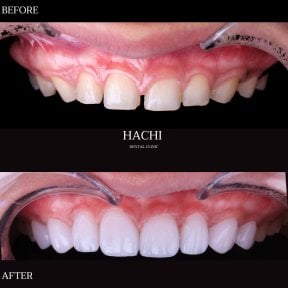Vorher-nachher-Ergebnisse von Porzellanveneers bei Hachi Dental Clinic & Digital Veneer Lab