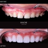Vorher-nachher-Ergebnisse von Porzellanveneers bei Hachi Dental Clinic & Digital Veneer Lab