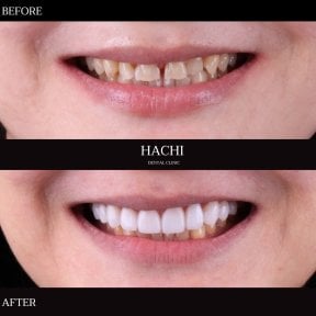 Vorher-nachher-Ergebnis von Porzellanveneers bei Hachi Dental Clinic & Digital Veneer Lab