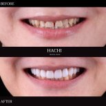 Vorher-nachher-Ergebnis von Porzellanveneers bei Hachi Dental Clinic & Digital Veneer Lab