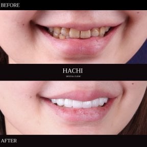 Vorher-nachher-Ergebnis Porzellanveneers bei Hachi Dental Clinic & Digital Veneer Lab, neues Lächeln