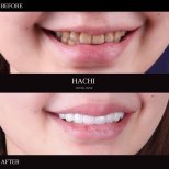 Vorher-nachher-Ergebnis Porzellanveneers bei Hachi Dental Clinic & Digital Veneer Lab, neues Lächeln